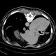 Adenocarcinoma of gallbladder, fistula to colon: CT - Computed tomography